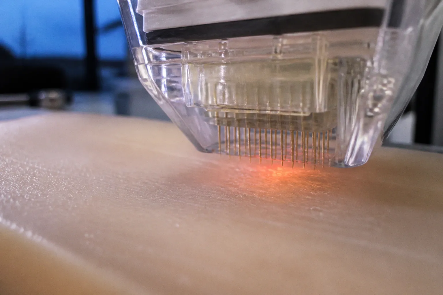 Microneedling RF : notre test de diffusion thermique